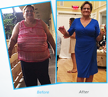 Success Stories or testimonials  of Dr.Shillingford about  Gastric Sleeve Weight Loss1