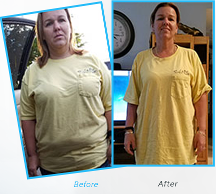 Success Stories or testimonials  of Dr.Shillingford about  Gastric Sleeve 2