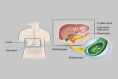 Bariatric Patients at High Risk of Gallstones