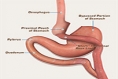 Bariatric Surgery (Lap Band, Gastric Bypass) Helps with Long Term Remission of Diabetes!