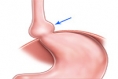 Do You Get Short of Breath After Eating? Could Be a Hiatus Hernia