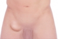 How To Tell If You Have a Femoral Hernia