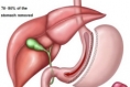 Sleeve Gastrectomy Diet