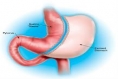 Sleeve Gastrectomy’s Benefits