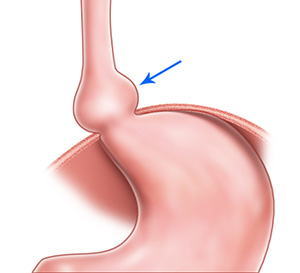 Do You Get Short of Breath After Eating Could Be a Hiatus Hernia