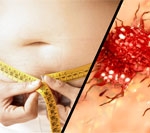 Weight Loss Surgery Lowers Risk of Some Cancers